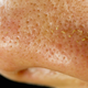 Illustration for article titled There Are Tiny Mites Living in Your Skin Pores and Fucking on Your Face
